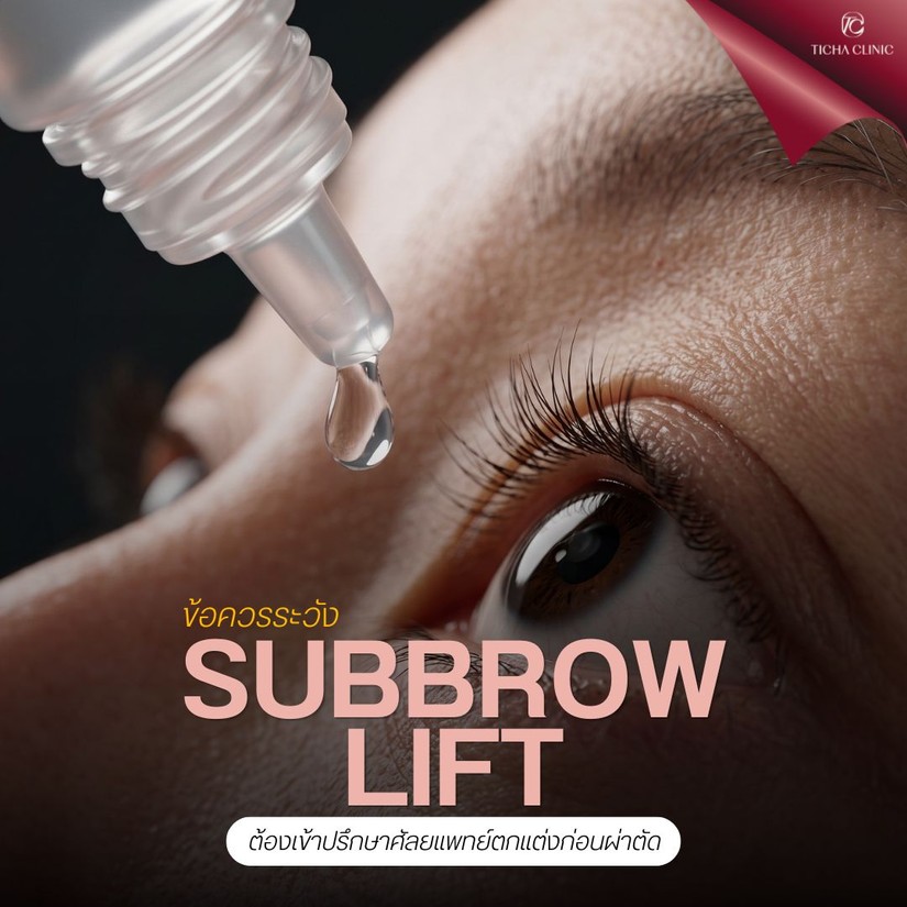 4.3 TC _ ทำไม Subbrow Lift ถึงช่วยลดริ้วรอยรอบดวงตาและรอยตีนกาได้ด้วย_