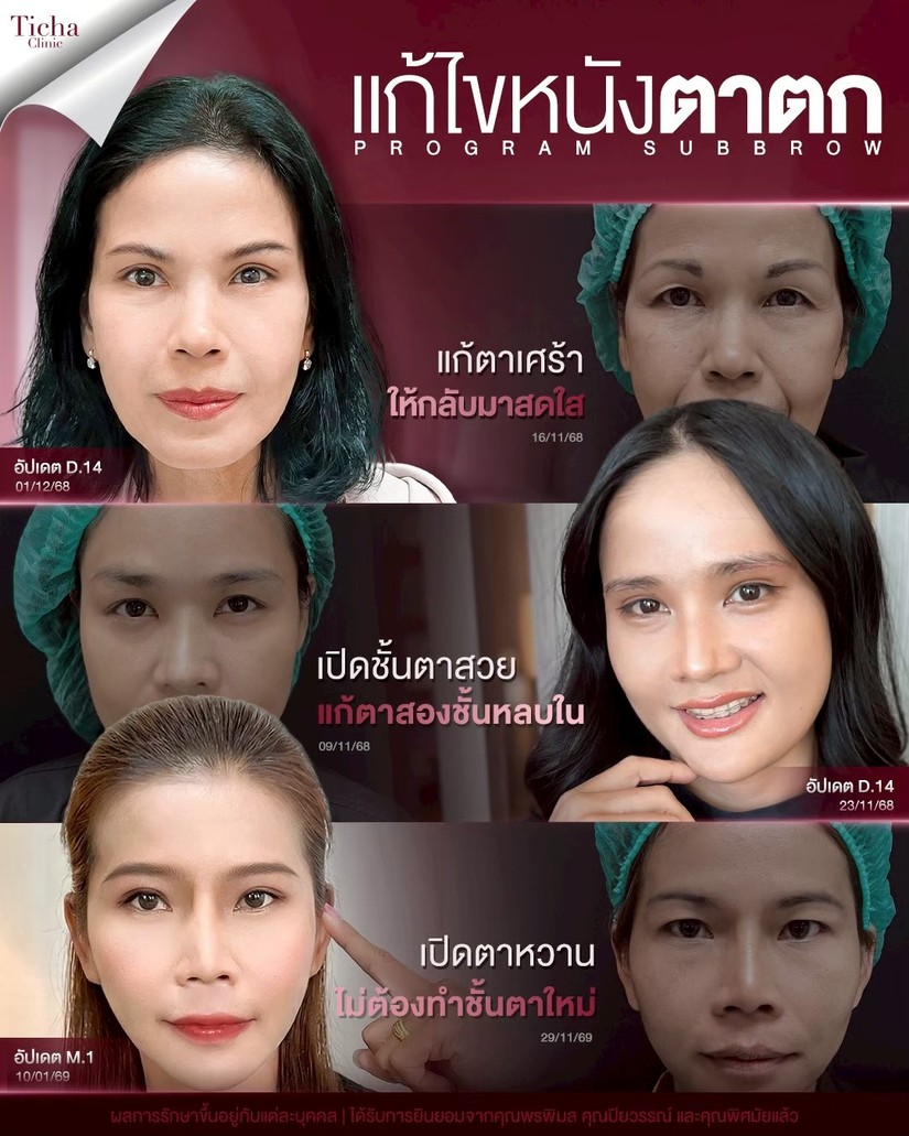 LINE_ALBUM_ซับบราว-Subbrow TC_261014_2