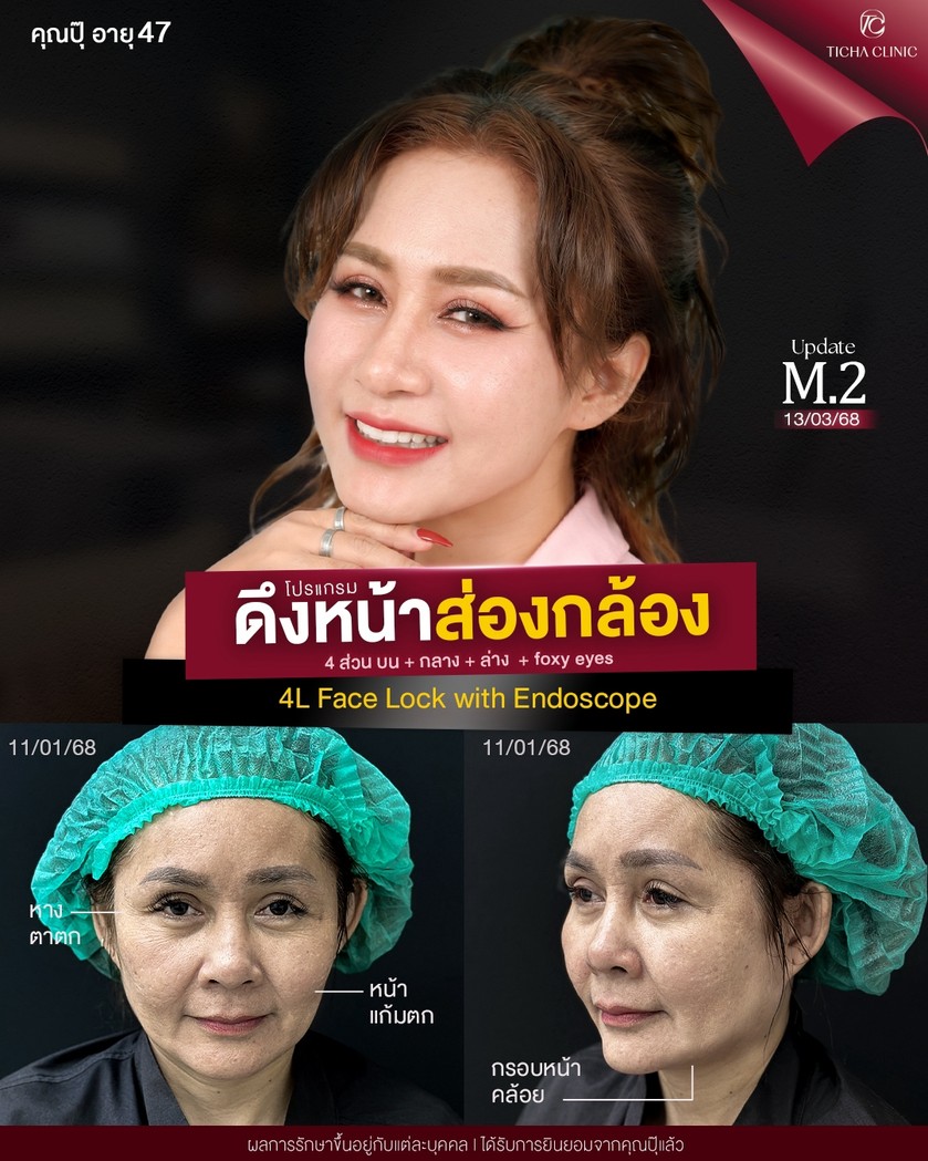 LINE_ALBUM_ดึงหน้า Face Lock TC_261012_1
