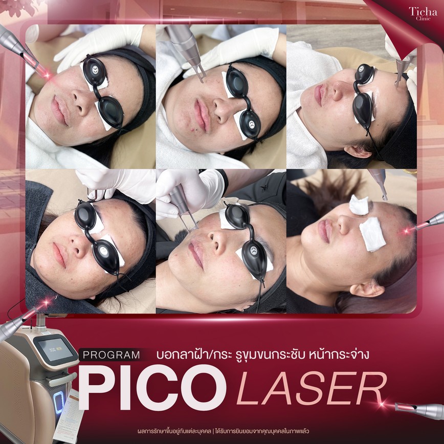 17.4 TC _ กระ ฝ้า แดดสะสมจากทริปทะเล Pico Laser ลบรอยดำฝังลึก ปรับผิวเนียนใสในกี่เซสชัน_