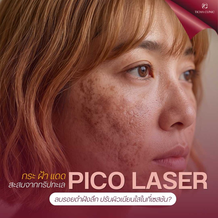 17.1 TC _ กระ ฝ้า แดดสะสมจากทริปทะเล Pico Laser ลบรอยดำฝังลึก ปรับผิวเนียนใสในกี่เซสชัน_