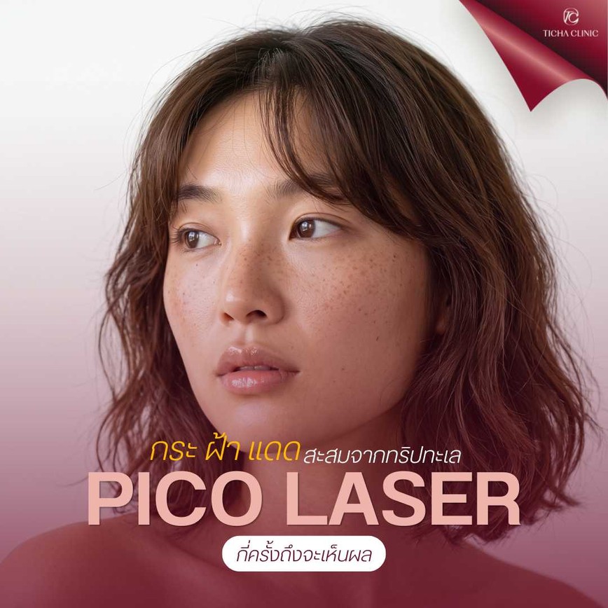 17.3 TC _ กระ ฝ้า แดดสะสมจากทริปทะเล Pico Laser ลบรอยดำฝังลึก ปรับผิวเนียนใสในกี่เซสชัน_