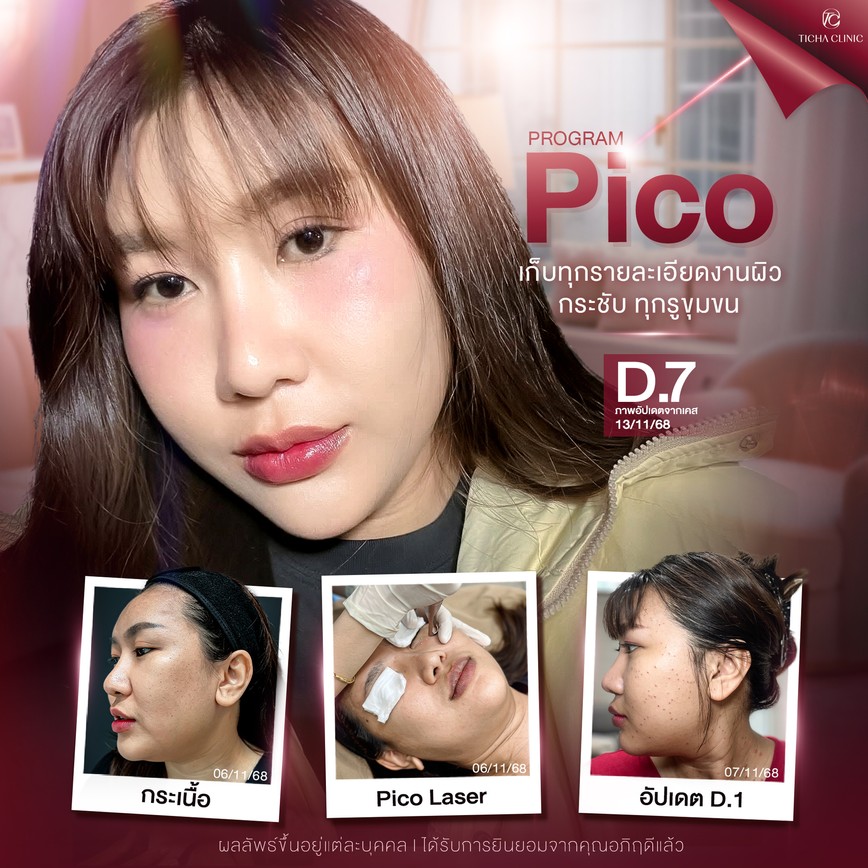 17.2 TC _ กระ ฝ้า แดดสะสมจากทริปทะเล Pico Laser ลบรอยดำฝังลึก ปรับผิวเนียนใสในกี่เซสชัน_