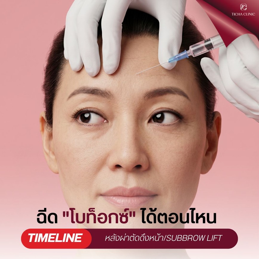 30.2 TC _ หลังทำดึงหน้า_Subbrow Lift สามารถฉีดโบท็อกซ์หรือฟิลเลอร์ต่อได้ตอนไหน_