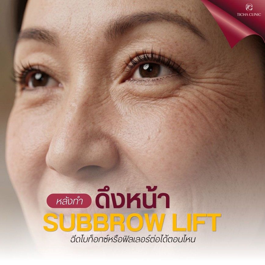 30.1 TC _ หลังทำดึงหน้า_Subbrow Lift สามารถฉีดโบท็อกซ์หรือฟิลเลอร์ต่อได้ตอนไหน_
