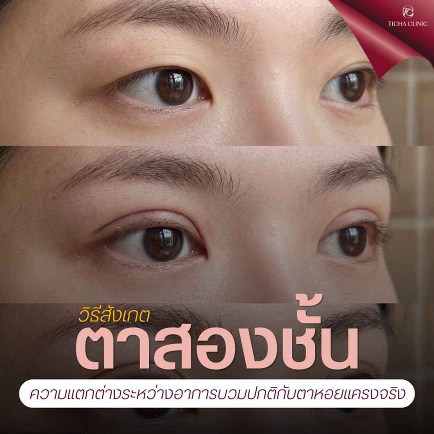 36.1 TC _ ทำตาสองชั้นมาแล้วหนาเป็นหอยแครง หน้าดูดุ เกิดจากอะไรและมีวิธีผ่าตัดแก้ไขอย่างไร_
