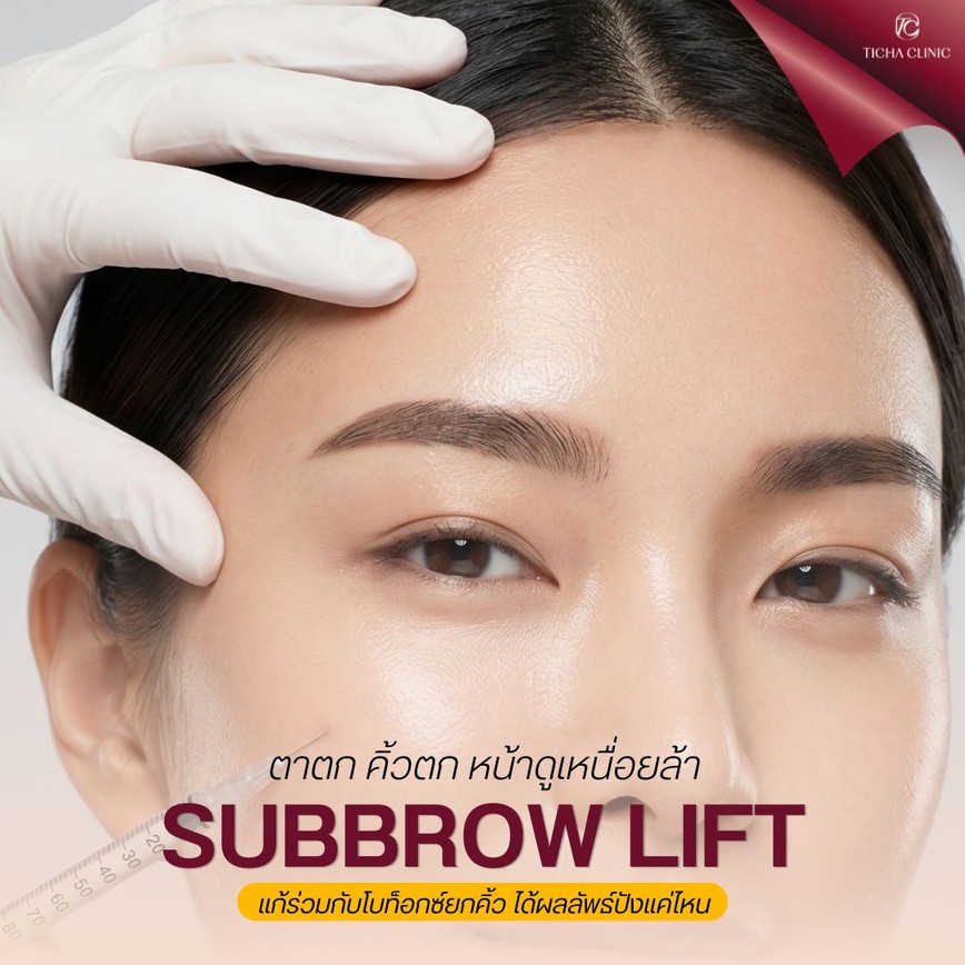 37.1 TC _ ตาตก คิ้วตก หน้าดูเหนื่อยล้า แก้ด้วย Subbrow Lift ร่วมกับโบท็อกซ์ยกคิ้ว ได้ผลลัพธ์ปังแค่ไหน__