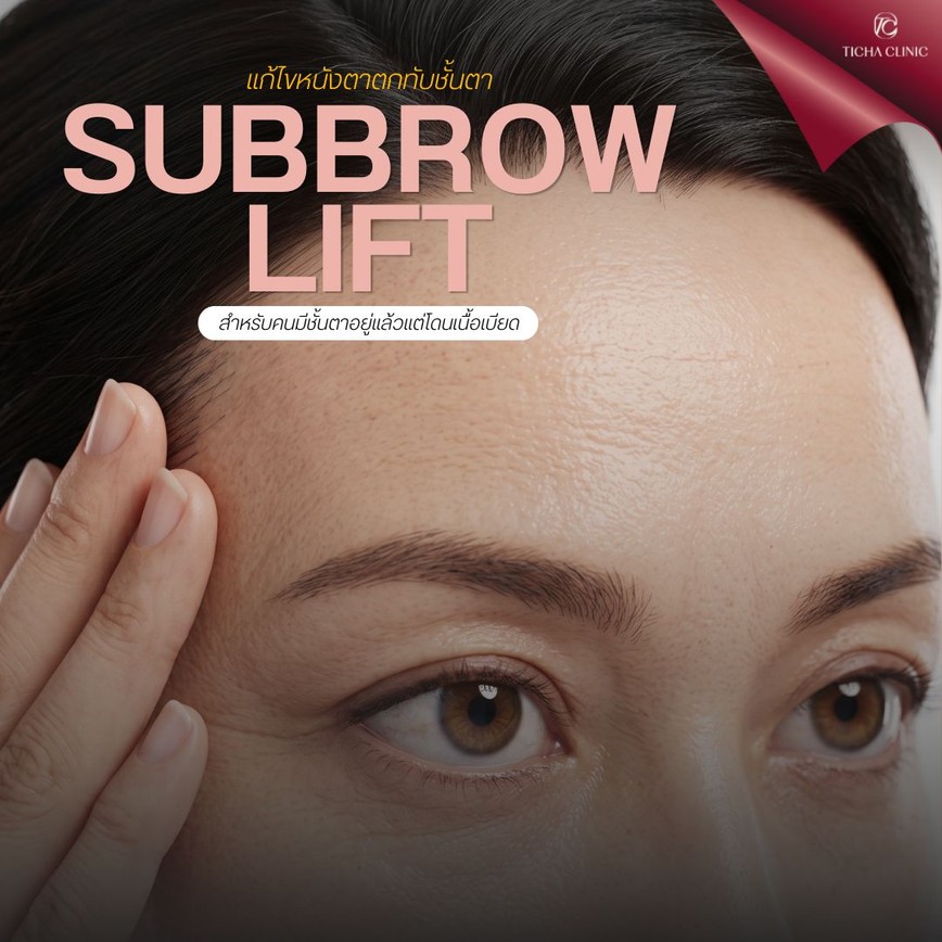 49.1 TC _ รีวิว Subbrow Lift แก้ไขหนังตาตกทับชั้นตา สำหรับคนมีชั้นตาอยู่แล้วแต่โดนเนื้อเบียด