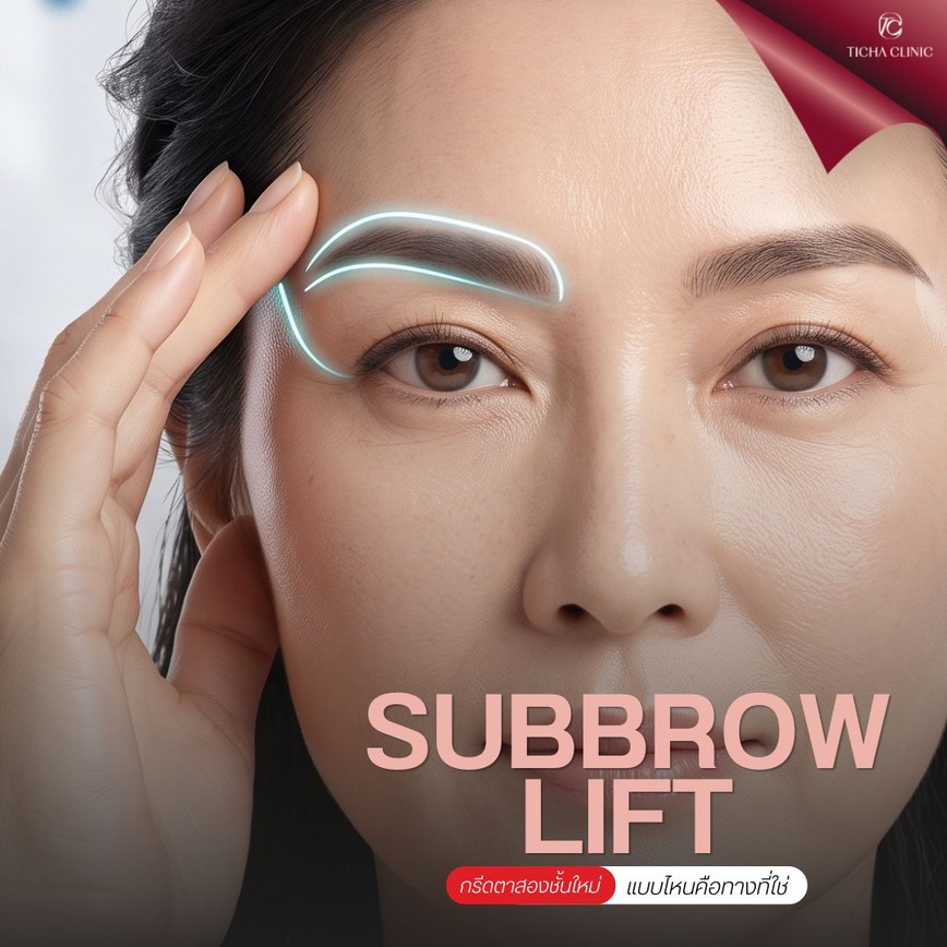 49.3 TC _ รีวิว Subbrow Lift แก้ไขหนังตาตกทับชั้นตา สำหรับคนมีชั้นตาอยู่แล้วแต่โดนเนื้อเบียด