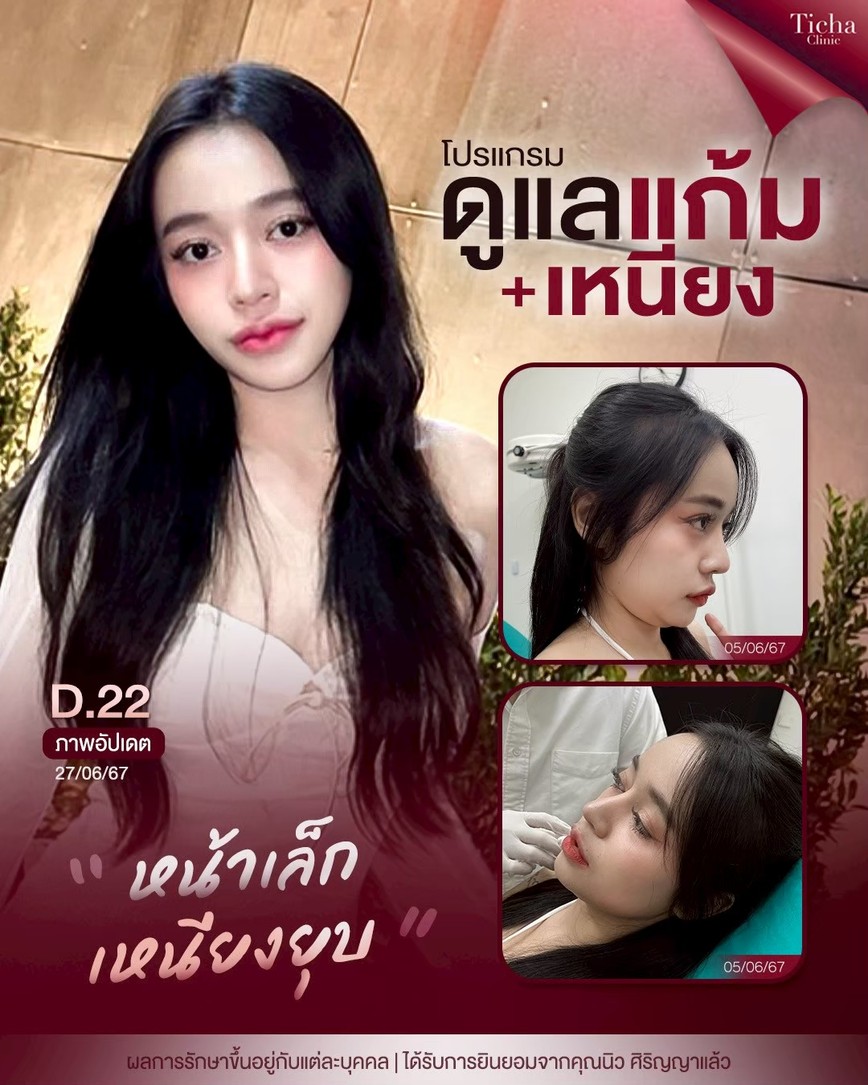 LINE_ALBUM_Skin Ticha - 3_260808_4