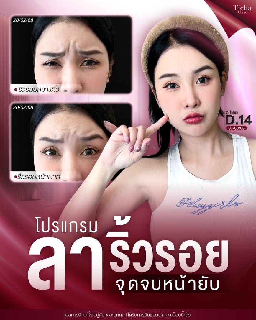LINE_ALBUM_Skin Ticha - 3_260904_1