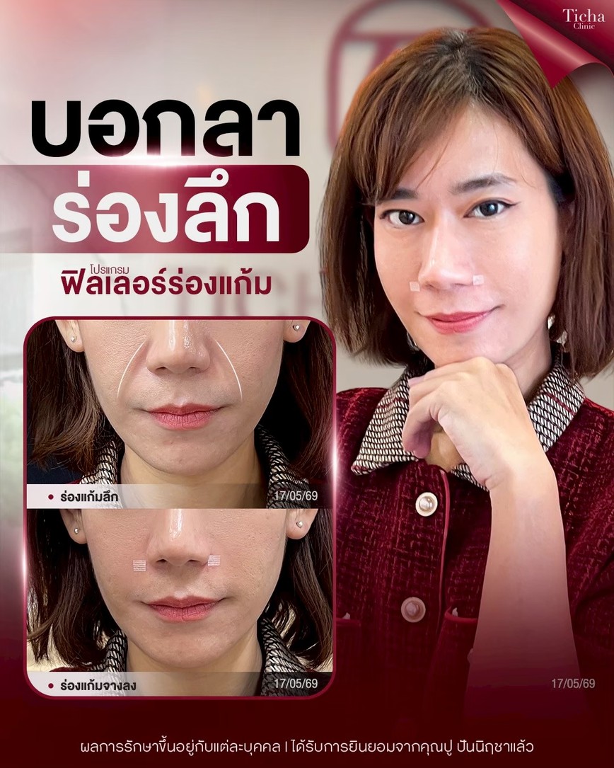 LINE_ALBUM_Skin Ticha - 3_260911_1