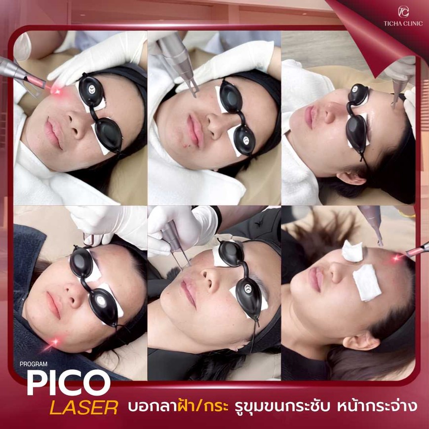 40.4 TC _ Pico Laser รักษารอยแผลเป็นจากสิว ยิงแล้วหน้าจะลอกเป็นสะเก็ดไหม_ วิธีดูแลผิวหลังทำ Pico