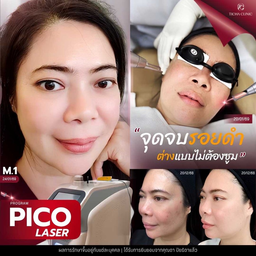40.5 TC _ Pico Laser รักษารอยแผลเป็นจากสิว ยิงแล้วหน้าจะลอกเป็นสะเก็ดไหม_ วิธีดูแลผิวหลังทำ Pico