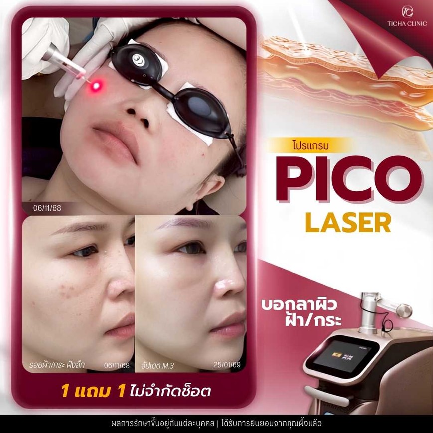 40.3 TC _ Pico Laser รักษารอยแผลเป็นจากสิว ยิงแล้วหน้าจะลอกเป็นสะเก็ดไหม_ วิธีดูแลผิวหลังทำ Pico