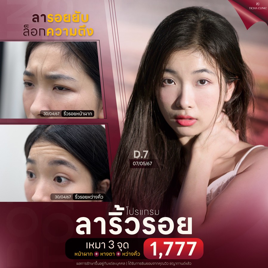 19.3 TC _ ฉีดโบท็อกซ์ริ้วรอยทำให้หน้าแข็ง จริงหรือแค่ความเชื่อ