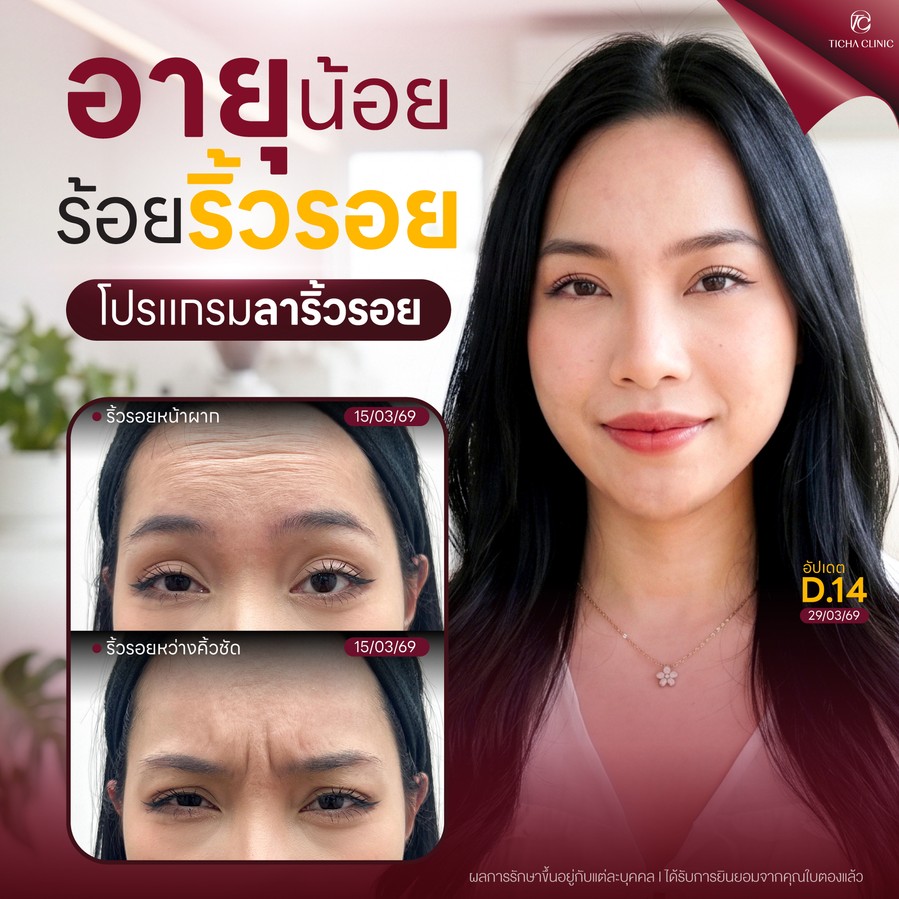 19.4 TC _ ฉีดโบท็อกซ์ริ้วรอยทำให้หน้าแข็ง จริงหรือแค่ความเชื่อ