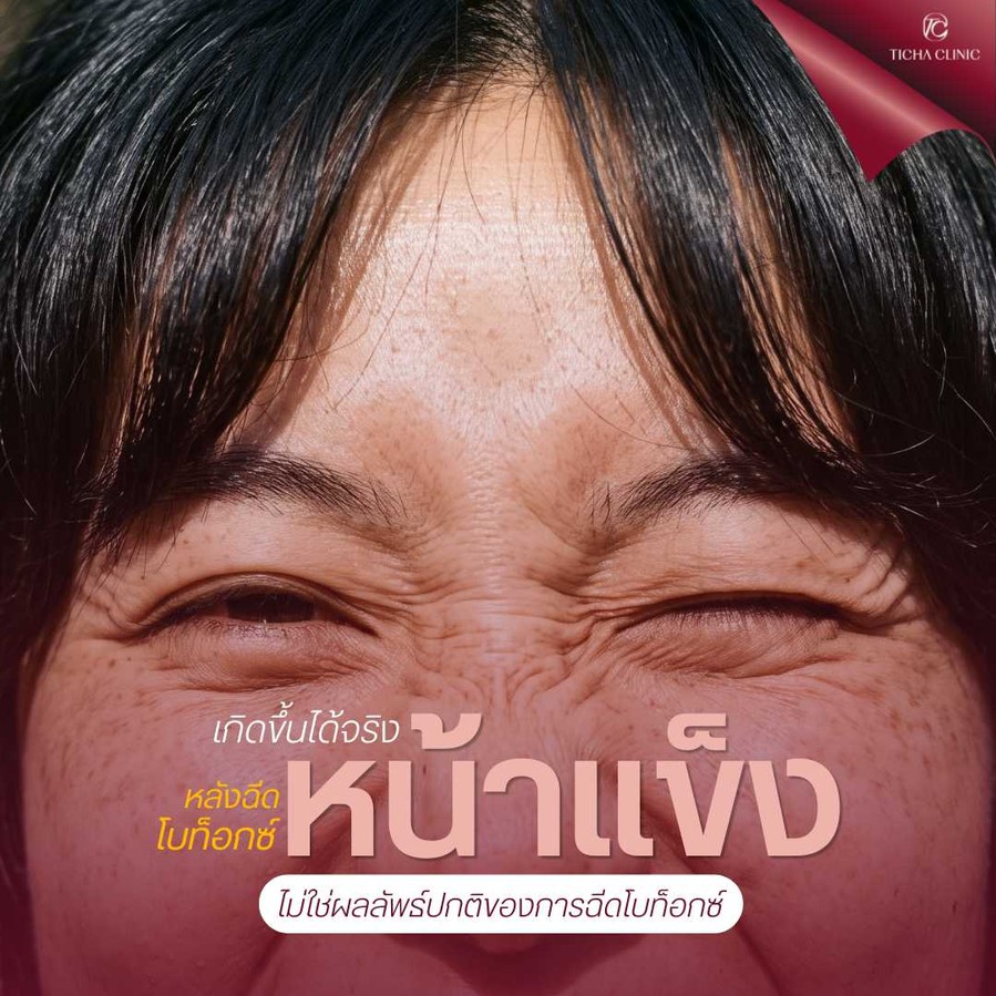 19.2 TC _ ฉีดโบท็อกซ์ริ้วรอยทำให้หน้าแข็ง จริงหรือแค่ความเชื่อ
