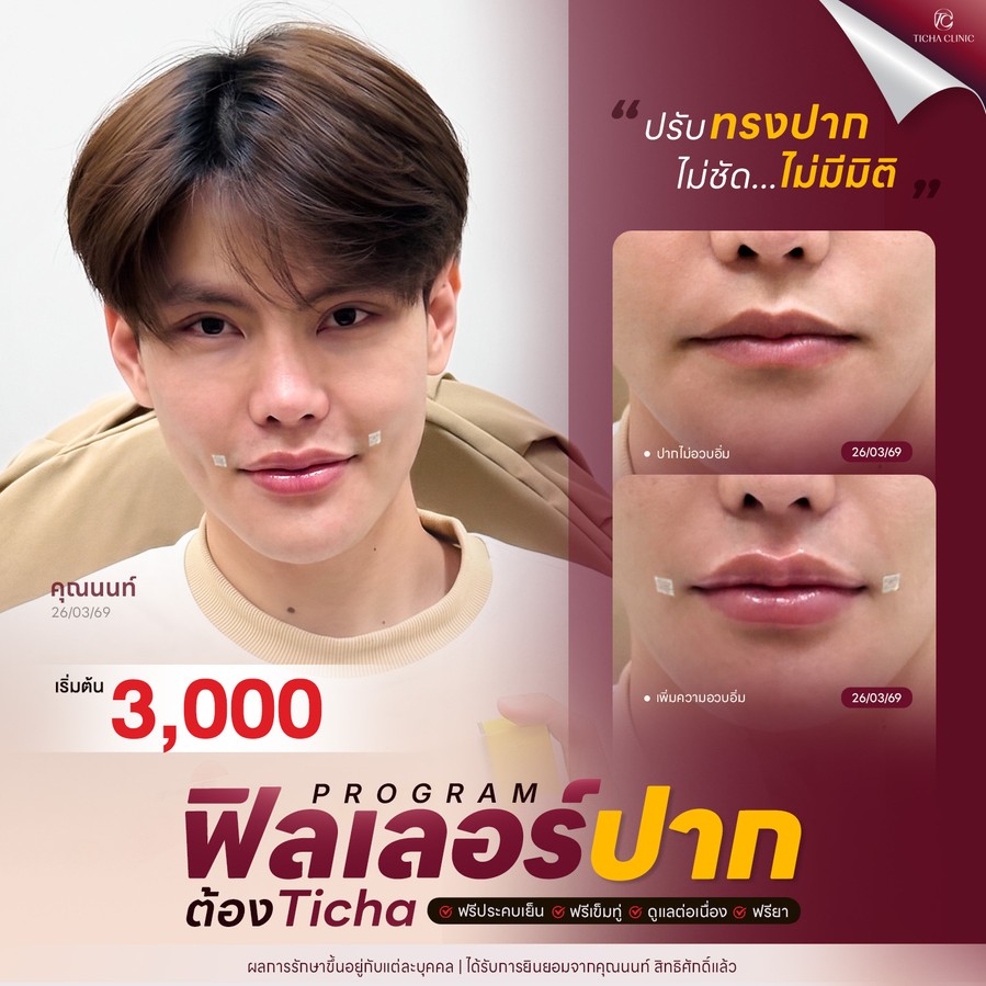21.4 TC _ ฟิลเลอร์ปากสายเกาหลี _Dolly Lips_ เน้นติ่งปากน่ารัก ละมุน เทคนิคเติมอย่างไรไม่ให้ดูเป็นก้อน