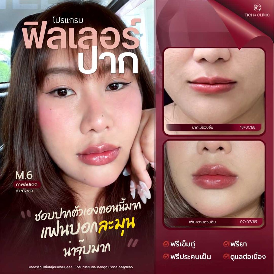 21.5 TC _ ฟิลเลอร์ปากสายเกาหลี _Dolly Lips_ เน้นติ่งปากน่ารัก ละมุน เทคนิคเติมอย่างไรไม่ให้ดูเป็นก้อน