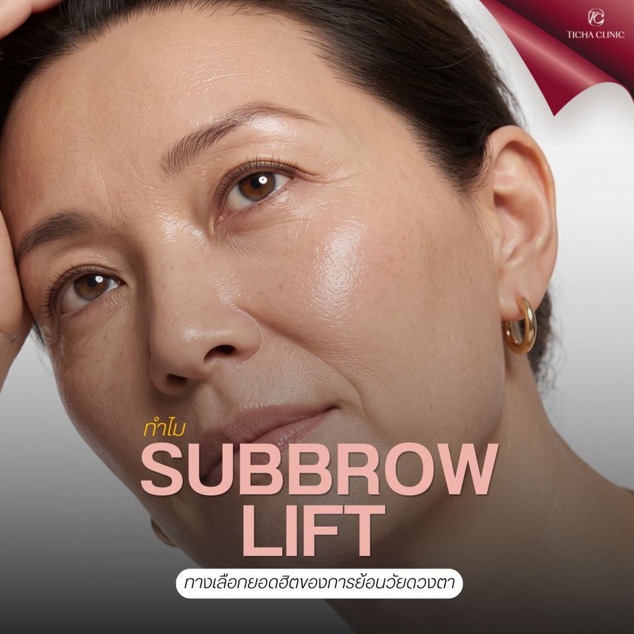45.2 TC _ Subbrow Lift ทำแล้วตาจะผิดรูปไหม_ วิธีหลีกเลี่ยงภาวะแทรกซ้อนหลังผ่าตัด
