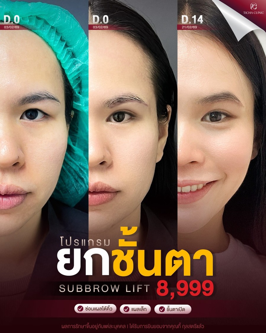 LINE_ALBUM_ซับบราว-Subbrow TC_260918_1