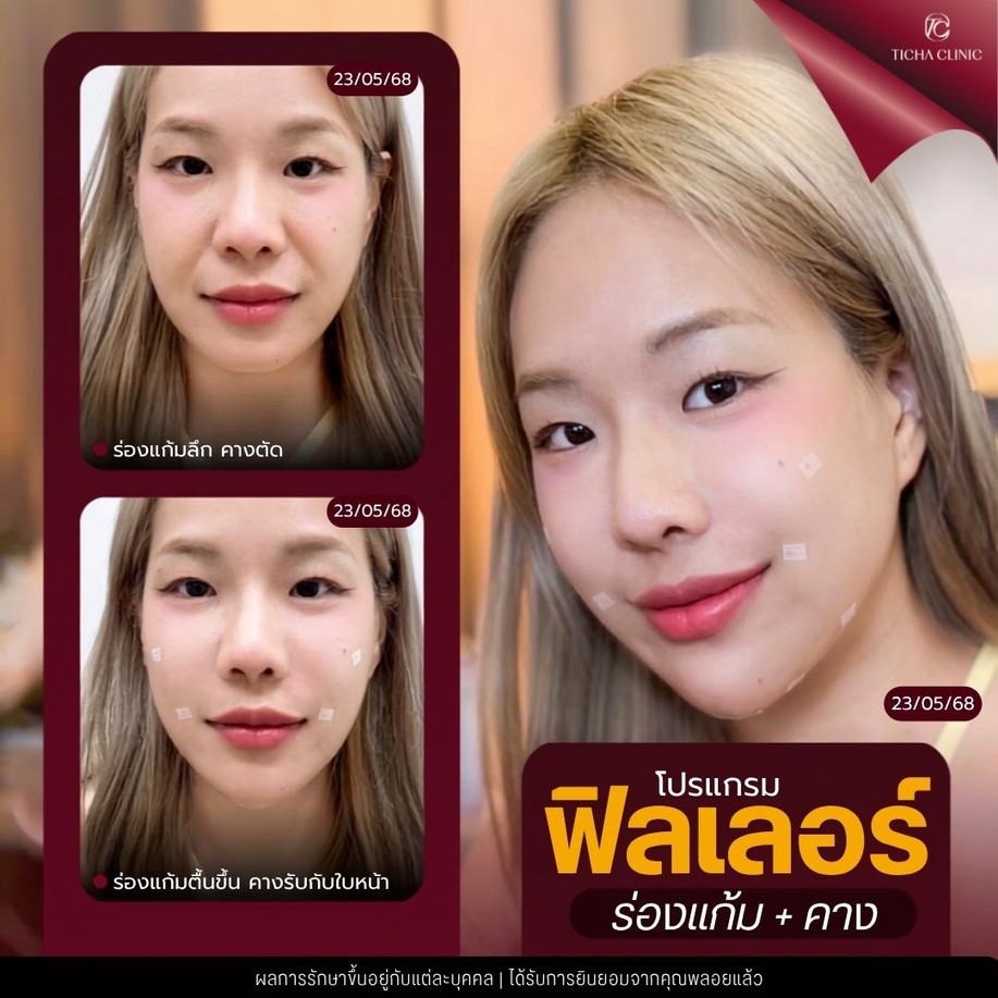 33.4 TC _ ฟิลเลอร์ร่องแก้ม เหมาะกับใคร ทำแล้วหน้าเด็กขึ้นไหม