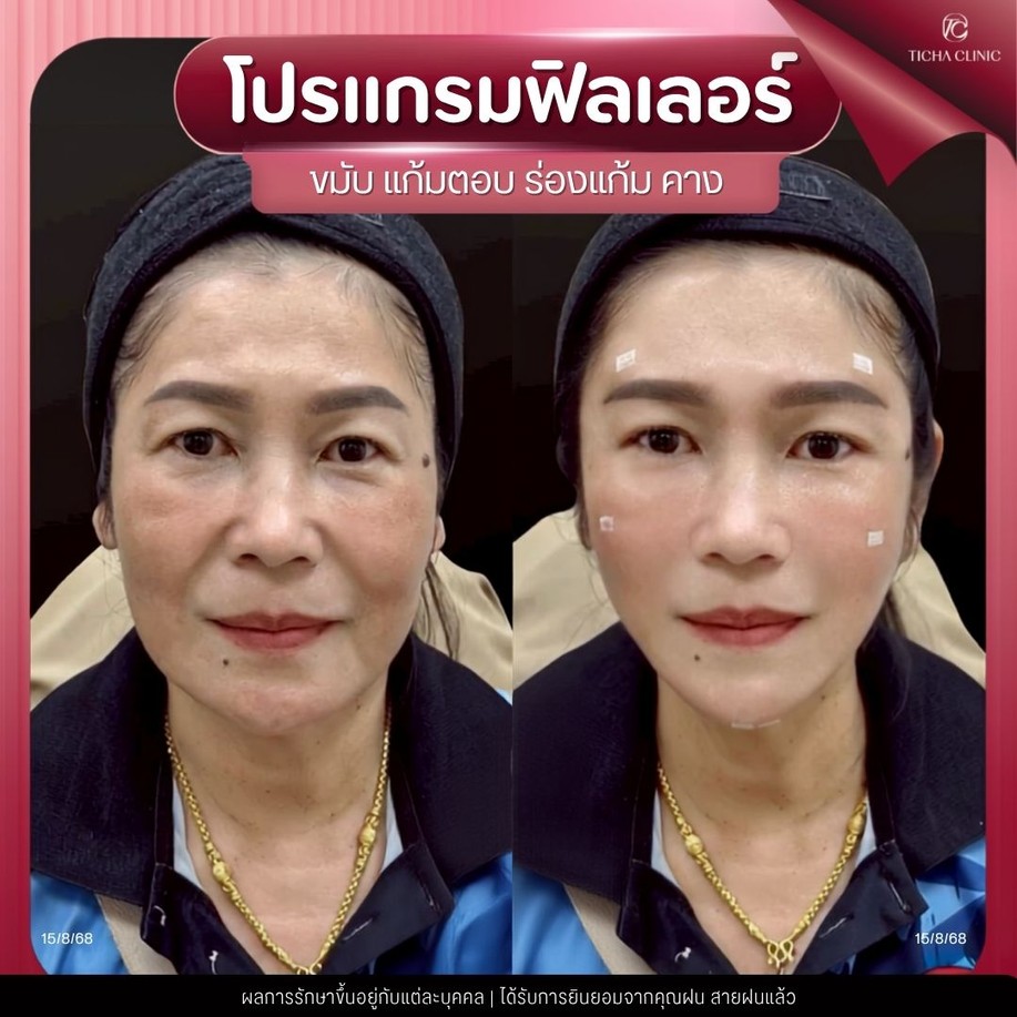 33.5 TC _ ฟิลเลอร์ร่องแก้ม เหมาะกับใคร ทำแล้วหน้าเด็กขึ้นไหม