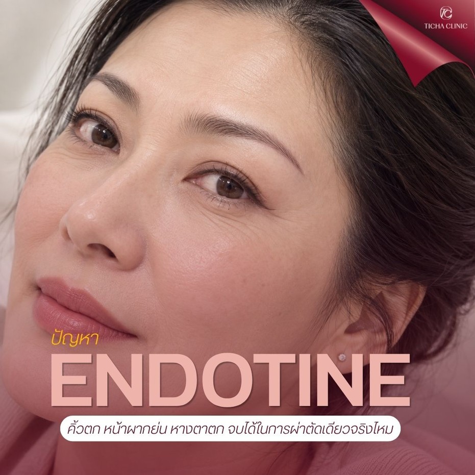 9.2 TC _ ยกคิ้ว Endotine แก้ปัญหาอะไรได้บ้าง_ คิ้วตก หน้าผากย่น หางตาตก จบได้ในการผ่าตัดเดียวจริงไหม