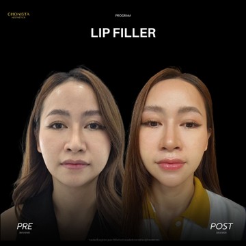 LIP01