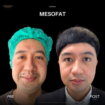 MESOFAT01