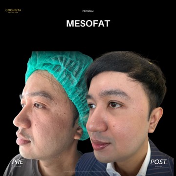 MESOFAT02