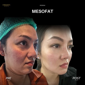 MESOFAT03