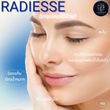 RADIESSEฉีดจุดไหนได้บ้าง