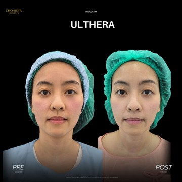 ULTHERA3001