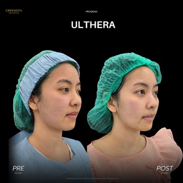 ULTHERA3002