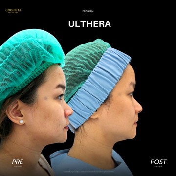 ULTHERAเหนียงผญ02