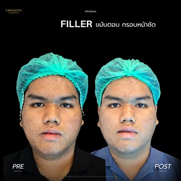 ฟิลเลอร์กรบหน้าชัดตัวยู01