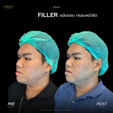 ฟิลเลอร์กรบหน้าชัดตัวยู02