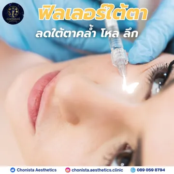 ฟิลเลอร์ใต่ตาคืออะไร1038765878748