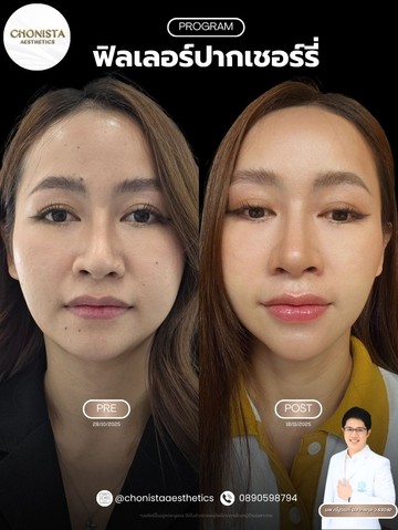 รีวิวฟิลเลอร์ปาก01