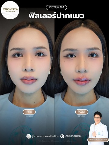 รีวิวฟิลเลอร์ปาก03