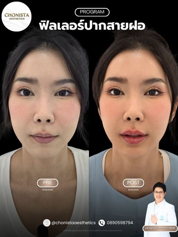รีวิวฟิลเลอร์ปาก05