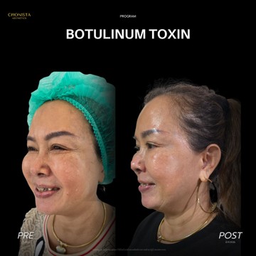 โบตีนการิ้วรอย02