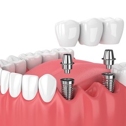 vsmiledentalclinic-services6