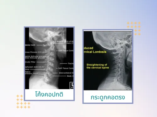 โค้งคอปกติ(1)