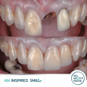 LINEALBUMAnInspiredSmileDentalImplant2303140