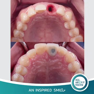 LINEALBUMAnInspiredSmileDentalImplant2303142