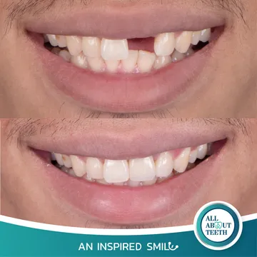 LINEALBUMAnInspiredSmileDentalImplant2303143