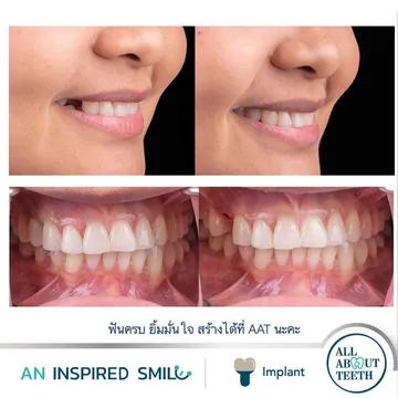 LINEALBUMAnInspiredSmileDentalImplant2303144